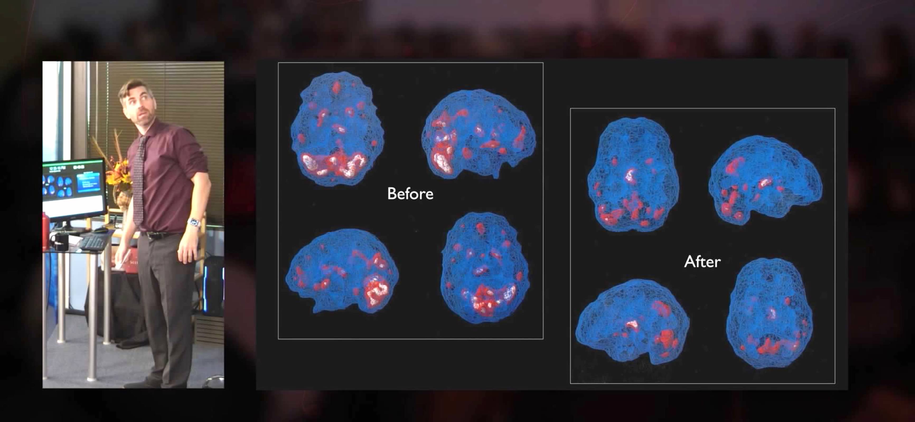 Brain scans Before and After neurofeedback